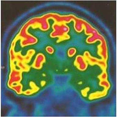 Case Report: Cognitive Assessment Before an Amnesic Seizure in Transient Epileptic Amnesia Syndrome